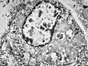 M,5m. | intracellular cholestasis - atresia of biliary ducts M,5m. | intracellular cholestasis - atresia of biliary ducts